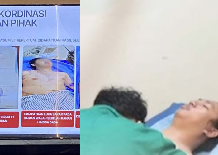 RSCM Beberkan Kondisi Andrie Yunus Pasca Serangan Air Keras, Ini Dampaknya
