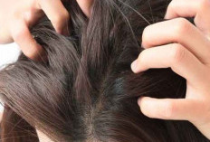 Cara Ampuh Mengatasi Kutu Rambut dengan Minyak Kayu Putih 