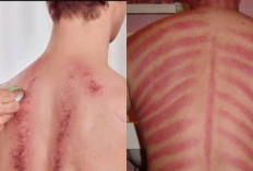 Benarkah Kerokan Bisa Membantu Mengatasi Masuk Angin? Yuk Rasakan Manfaatnya Tanpa Efek Samping