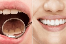 5 Rekomendasi Obat Penghilang Karang Gigi di Apotik, Aman dan Bikin Bersih, Yuk Simak..