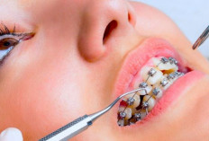 Berikut 7 Tips Perawatan Khusus untuk Gigi Kawat yang Harus Kamu ketahui, Simak Disini!