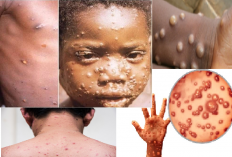 Viral TikTok Kasus Monkeypox Merajalela di Jakarta Kemenkes Siapkan Vaksinasi Mpox Untuk 5 Orang