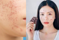 5 Makanan Pemicu Jerawat Membandel, Hindari Agar Kulit Kembali Bersih