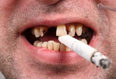 Senyum Menyeramkan Akibat Rokok: Cara Mengatasi Karang Gigi
