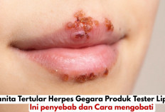Viral! Wanita Tertular Herpes Gegara Produk Tester Lipstik, Ini penyebab dan Cara mengobati Girls Wajib Tau