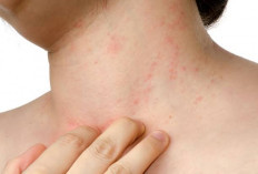 13 Penyebab Bintik Merah pada Kulit dari Dermatitis Hingga Psoriasis, Begini Cara  Mengatasinya?