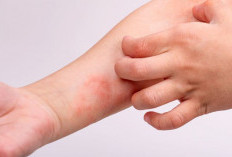 Si Kecil Rewel Karena Gatal? Waspadai Dermatitis Atopik, Begini Gejala, Penyebab, dan Cara Mengatasinya
