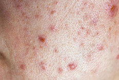 6 Cara Merawat Kulit agar Bebas Jerawat Tanpa Ribet, Nggak Butuh Skincare Mahal