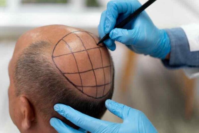 Nggak Pede Karena Botak? 5 Syarat Utama Sebelum Transplantasi Rambut