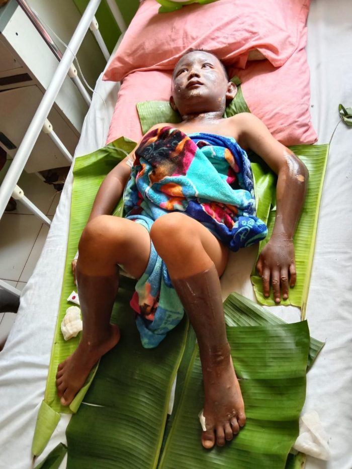 2 Anak Korban Ledakan Jaringan Gas Rumah Tangga di Prabumulih Sering Merintih Ketakutan